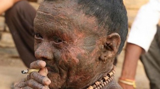 Un hombre cambia su piel cada 10 días por una extraña enfermedad