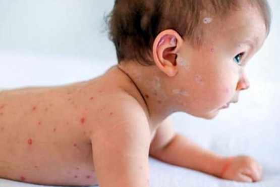 Alerta: son tres los casos de sarampión en menos de un mes