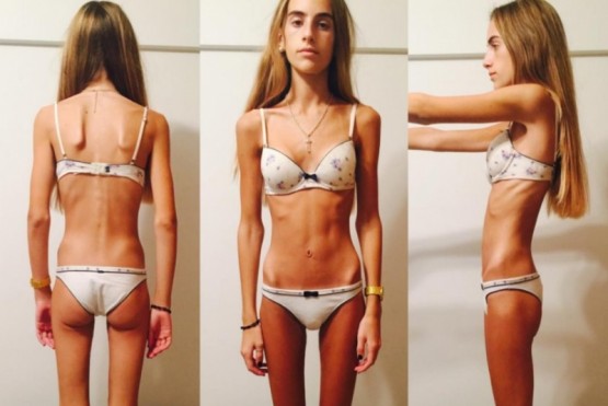 Mostró los estragos de la anorexia y causó revuelo en las redes: “Llegué a pesar 35 kilos