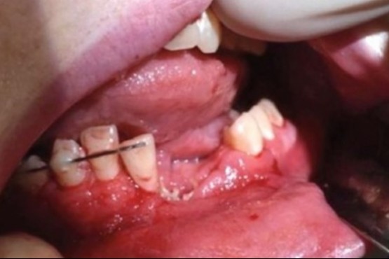 Un joven estadounidense de 17 años acabó con varios dientes rotos y una fractura de mandíbula tras explotarle un cigarrillo  electrónico en la boca (The New England Journal of Medicine).