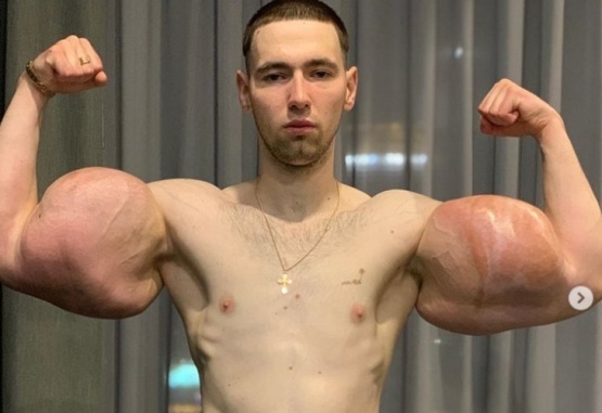 Kirill Tereshin tiene 23 años y comenzó a inyectarse aceite en sus brazos desde muy joven.
