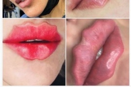 Una nueva y peligrosa moda viral: ‘Labios del Diablo’