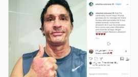 Sebastián Estevanez mostró cómo quedó su cara luego del accidente
