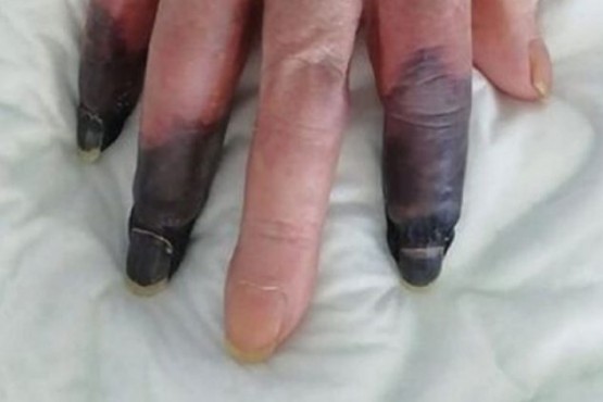 Perdió 3 dedos a raíz de una gangrena generada por el coronavirus