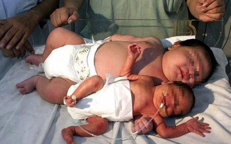 Un bebé recién nacido que mas pesa en el mundo 