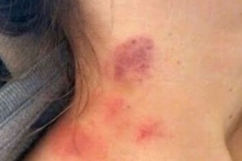 Una maestra descubrió que una niña era abusada por su padrastro en Orán por una marca en el cuello