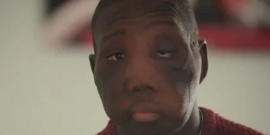 La transformación de un joven al que le extirparon un tumor que le desfiguró el rostro: “Miedo era lo único que sentía”