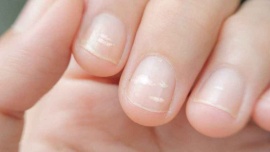 Lo que tus uñas dicen sobre tu salud: cómo detectar enfermedades