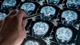 Día Mundial del Alzheimer: cómo detectarlo