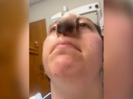 Un perro le arrancó la nariz y ahora le salen pelos de la cara