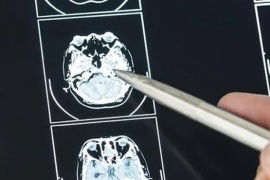 Cada día se detectan en Argentina 5 casos de tumores cerebrales: ¿cuáles son los signos de alerta?