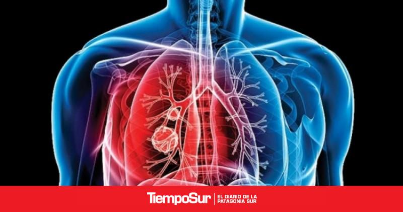 Tuberculosis: alerta por el aumento de casos en Argentina